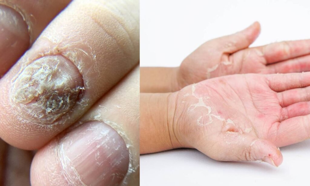 How To Cure Fungal Infection On Skin Naturally at Home